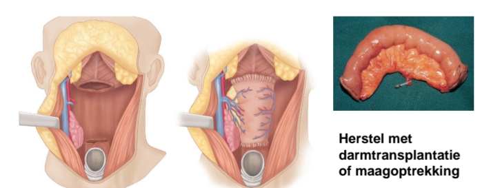 <p>Totale laryngectomie met partiële faryngectomie<br>reconstructie met vrije of gesteelde flap<br>Totale laryngofaryngectomie +/- oesofagectomie</p>