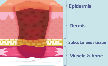 <p><strong>4 layers</strong> of skin damage </p><p>extends all the way down into muscle, bone, or tendon</p>