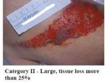 <ul><li><p>Partial tissue loss, considered scant when the loss is 25% or less and moderate </p></li><li><p>or loss when the tissue loss is more than 25%</p></li></ul><p></p>