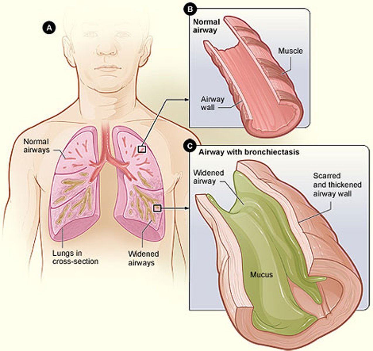 <p>dilation of the bronchi</p>
