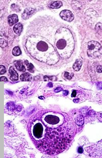 <ul><li><p><strong>Enveloped, dsDNA virus</strong></p></li><li><p><mark data-color="purple">Clinical Presentation:</mark></p><ul><li><p>Abnormalities seen in utero for congenital CMV</p><ul><li><p>Microcephaly, intracranial calcifications, occipital horn abnormalities, growth restriction, enlarged liver, pericardial effusion, placental inflammation, mortality, cerebral atrophy</p></li><li><p>Intracerebral calcifications (poor developmental prognosis)</p></li></ul></li></ul></li><li><p><mark data-color="yellow">Diseases:</mark></p><ul><li><p><strong>Mononucleosis</strong></p><ul><li><p>Fever, malaise, pharyngitis, rash, leukocytosis </p></li></ul></li><li><p><strong>Congenital CMV </strong></p><ul><li><p>Transplacental transmission risk</p></li><li><p>Most common intrauterine infection in U.S</p></li><li><p><strong>Most common cause of non-genetic hearing loss</strong></p></li></ul></li></ul></li><li><p><mark data-color="green">Diagnosis/Treatment </mark></p><ul><li><p><strong><u>NO heterophile antibodies</u></strong></p></li><li><p>Biopsy cells to see <strong><u>Owl’s Eye Nuclei</u></strong></p><ul><li><p>Large, basophilic (dark) nuclear inclusion, perinuclear halo, cytoplasmic inclusions</p></li></ul></li><li><p>Serological testing</p></li><li><p>Quantitative PCR</p></li><li><p>Treatment for Congenital: <span>oral valganciclovir for 6 months if symptomatic</span></p></li><li><p>Diagnosis for Congenital: Consider <strong>TORCH</strong></p><p></p></li></ul></li></ul>