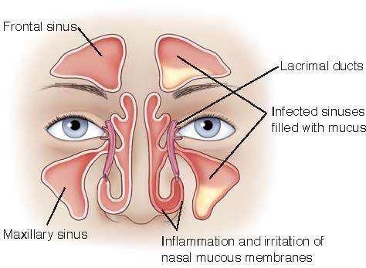 <p>-upper respiratory infection</p><p>-inflammation of the sinus cavities</p><p>-causes: viruses, bacteria, and fungi</p><p>-exudate collects and blocks sinus cavities</p><p>-acute: 4 weeks or chronic: more than 12 weeks with constant pain and leaking</p>
