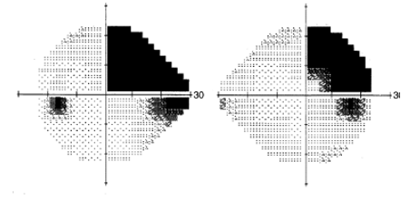 <p>describe this VF defect</p>