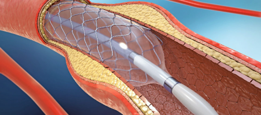 <p>In this procedure, guidewires and catheters are inserted through vascular access in groin, navigated to area of narrowing to reopen artery and perfuse leg. Which type of procedure is this? </p>