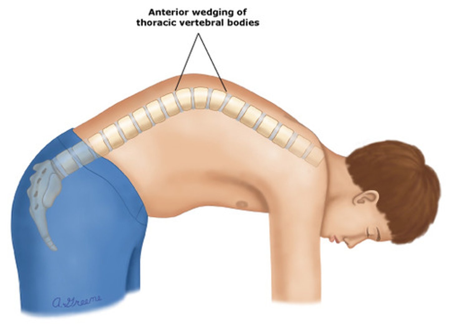 <p>anterior longitudinal ligament thickened, vertebral wedging, schmorl's nodes, and changes in vertebral end plates (flat and irregular)</p>