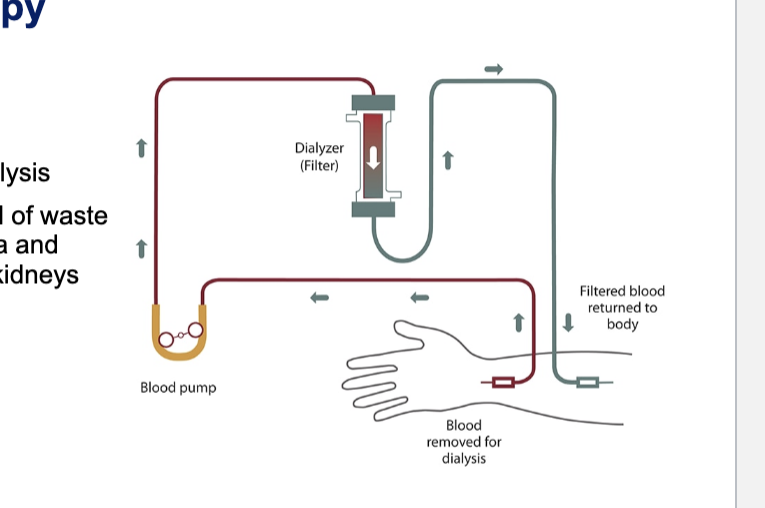 <ul><li><p>also known as haemodialysis or simply dialysis</p></li><li><p>achieves the extracorporeal removal of waste products such as creatinine and urea and free water from the blood when the kidneys are in a state of failure</p></li><li><p>diagram</p><ul><li><p>blood is removed from the body</p></li><li><p>blood pump actively draws blood from the dialysis circuit → ensures constant, controlled flow rate</p></li><li><p>dialyzer (filter) = artificial kidney</p><ul><li><p>blood flows thru semi-permeable membranes</p></li><li><p>waste products, excess ions, and fluid move across the membrane into the dialysate</p></li></ul></li><li><p>filtered blood is returned to the body</p></li></ul></li></ul><p></p>