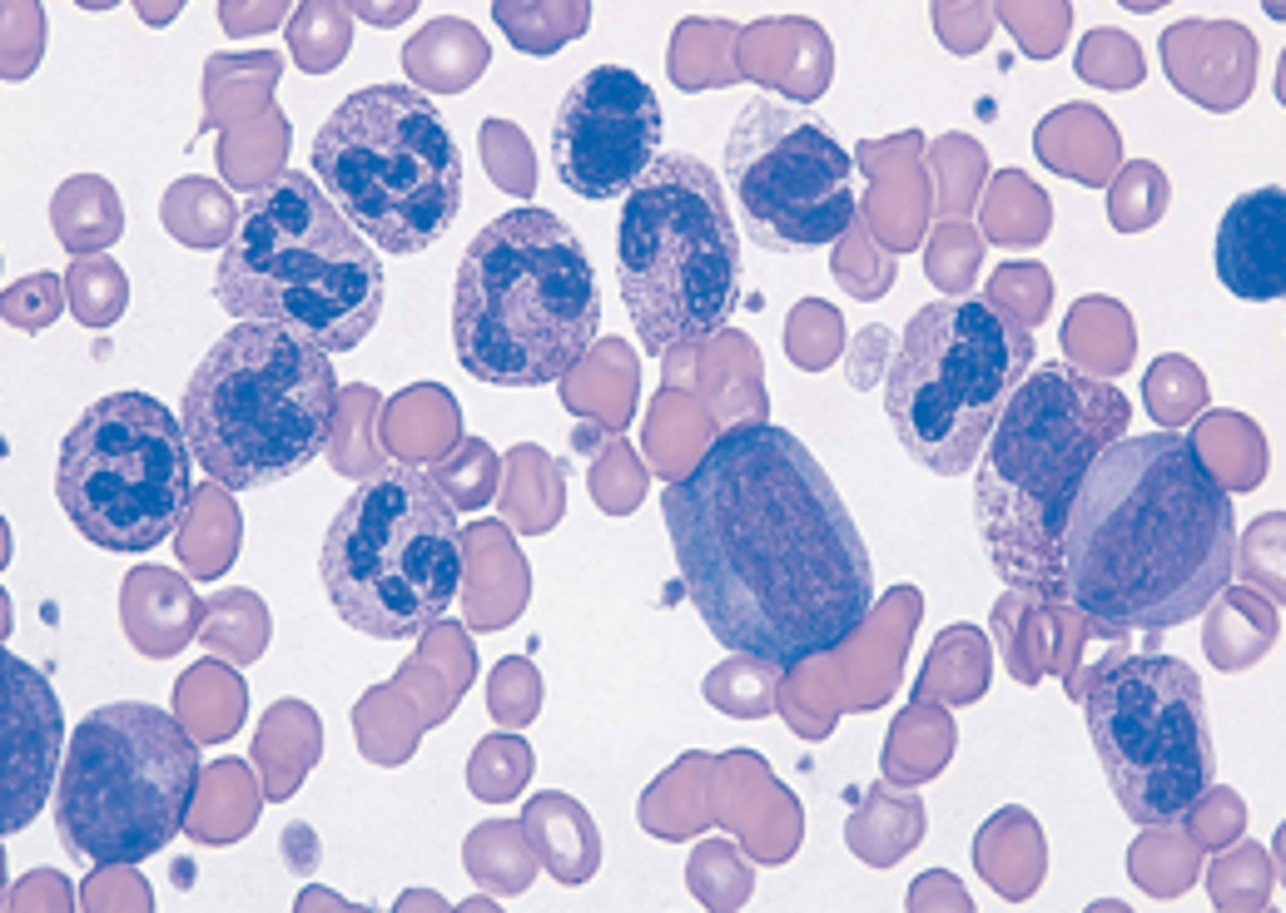 <p>Acute or Chronic leukemia?</p>