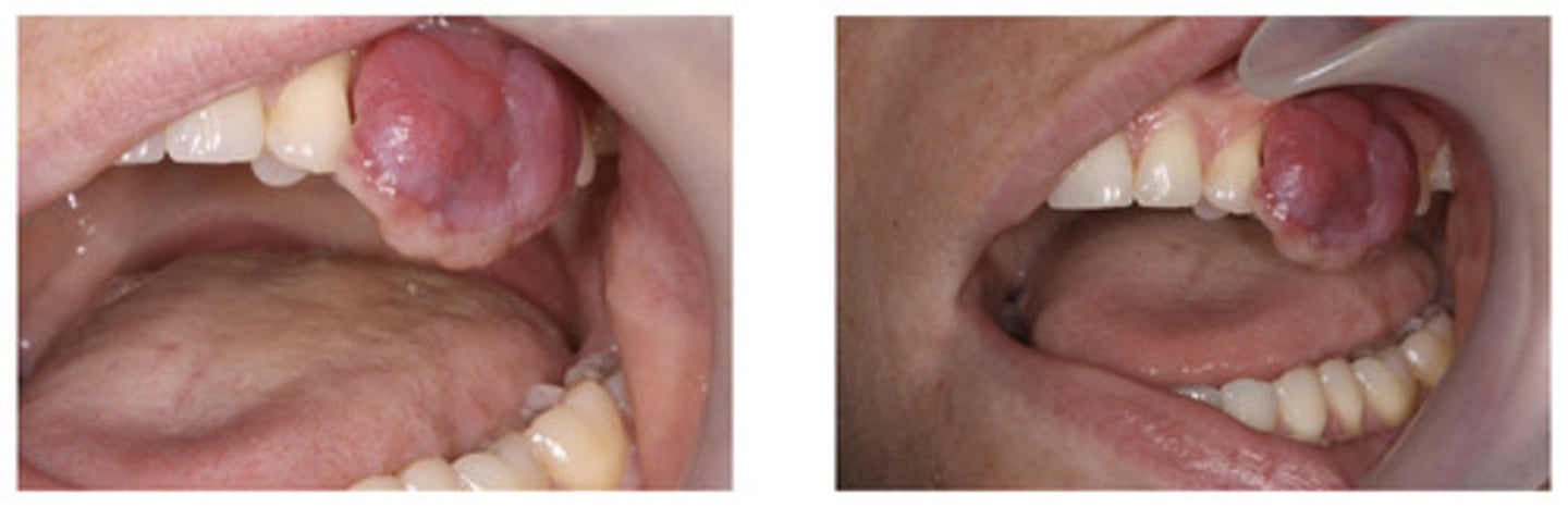 <p>Usually an over response to an irritant - can appear with or without good OH can be common in pregnancy - they are usually surgically removed</p>