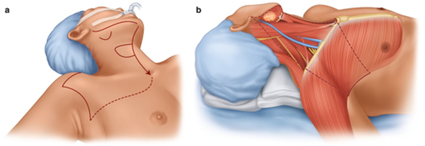 <p>- Airway compromise</p><p>- Speech and swallowing</p><p>- Trach insertion tray at bedside</p><p>- Bleeding</p><p>- Carotid artery rupture</p><p>- Nerve injury</p><p>- Splint surgical site if coughing</p><p>- PT/OT/Speech consults</p>