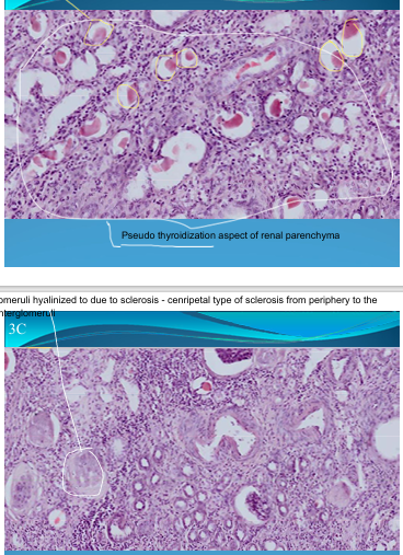 <p>KIDNEY:</p><p>Chronic Pyelonephritis: Tubules are dilated → contain hyaline cylinders; glomeruli hyalinized due to scelrosis - centripetal type of sclerosis from periphery to center of glomeruli. Pseudothyroidization of aspect of renal parenchyma </p>