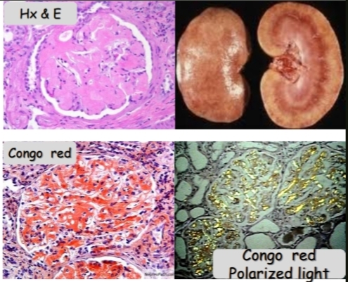 <p><strong> Amyloidosis of the kidney</strong></p><p>The stains used are: </p><p> Hx &amp; E stain: Eosinophilic material.</p><p> Congo red stain: Orange-red color.</p><p>Polarized light (after Congo red): Apple green birefringence.</p>