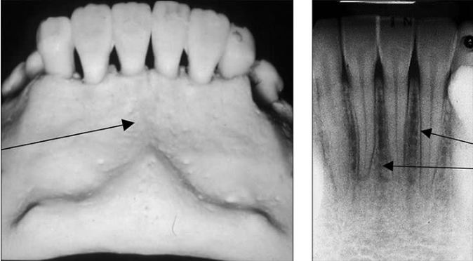 <p>Mental fossa</p><ul><li><p>scooped-out, depression of bone located on the external surface of the anterior mandible </p></li><li><p>Radiography: radiolucent area above the mental ridge </p></li></ul><p></p>