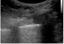 <p>What is lung sliding (B mode)?</p>