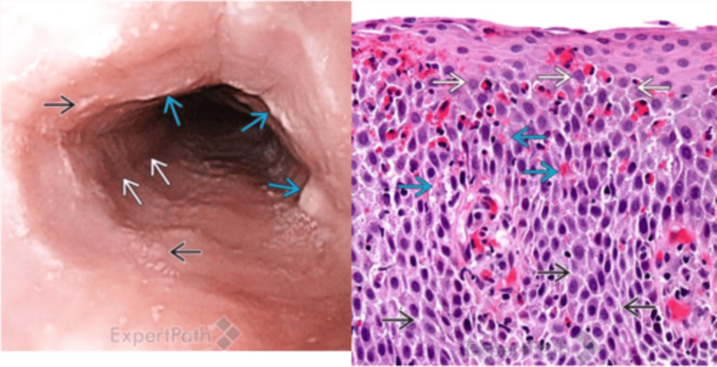 <p>Define Condition:</p><p>Inflammation of esophagus d/t CHRONIC IMMUNE REACTION; AKA "heart burn</p><p>-Hx:</p><p>&gt; Refractory to PPIs</p><p>&gt; A/w:</p><p>&gt;&gt; Atopic Dermatitis</p><p>&gt;&gt; Allergic Rhinitis</p><p>&gt;&gt; Asthma</p><p>&gt;&gt; Peripheral Eosinophilia</p><p>-Path: Chronic Immune Rxn to environmental and food allergens --&gt; deficient esophageal mucosal barrier</p><p>-Sx:</p><p>&gt; Children = Feeding intolerance &amp; GERD-like Sx</p><p>&gt; Adults = Food Impaction/Dysphagia</p><p>-Dx:</p><p>&gt; Biopsy: Eosinophilic Infiltration (&gt; 15 eos per hpf) FAR from GE Junction</p><p>&gt; Endoscopy: RINGS in upper esophagus</p><p>-Tx: Restrict food (allergies) + Steroids</p>