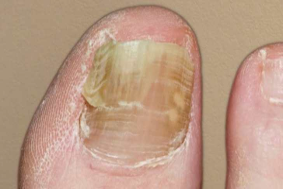 <p>fungal infection</p>