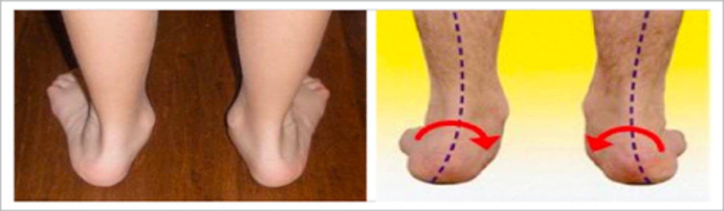 <p>Rearfoot deviated toward the outside resulting in prontated heel</p>