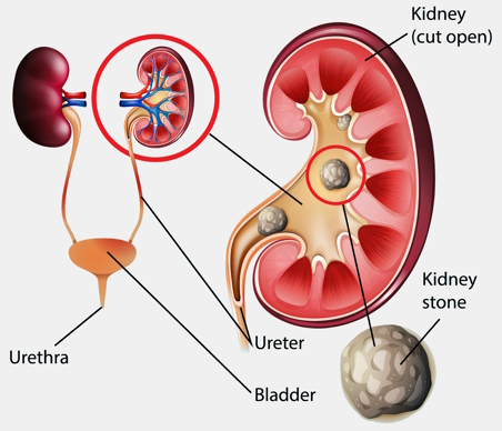 <p>Kidney stones</p>