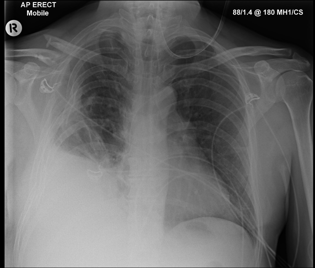 <p>Describe the abnormality demonstrated. </p>