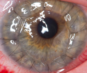 <p>surgery </p><ul><li><p>10-22% of pts with KCN require a corneal transplant</p></li><li><p>IF impossible to achieve stable CL fit, IF excessive scarring + thinning</p></li></ul>