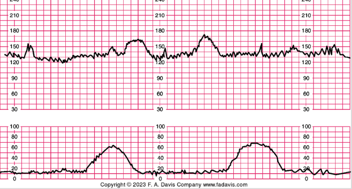 <p></p><p>- 32 wks or greater: 15 beats above baseline lasting 15 seconds</p><p>- before 32 wks: 10 beats or greater above baseline, lasting 10 or more seconds</p><p>- predict adequate fetal oxygenation and absence of fetal acidemia</p><p>- it is a good thing! it is okay to see several times, and also okay if not any or very little</p><p></p>