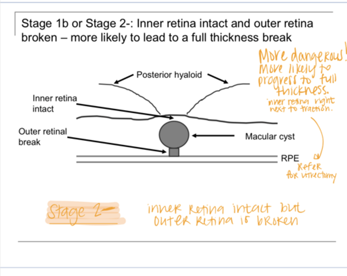 <p>Describe Stage 2- Macular Hole</p>