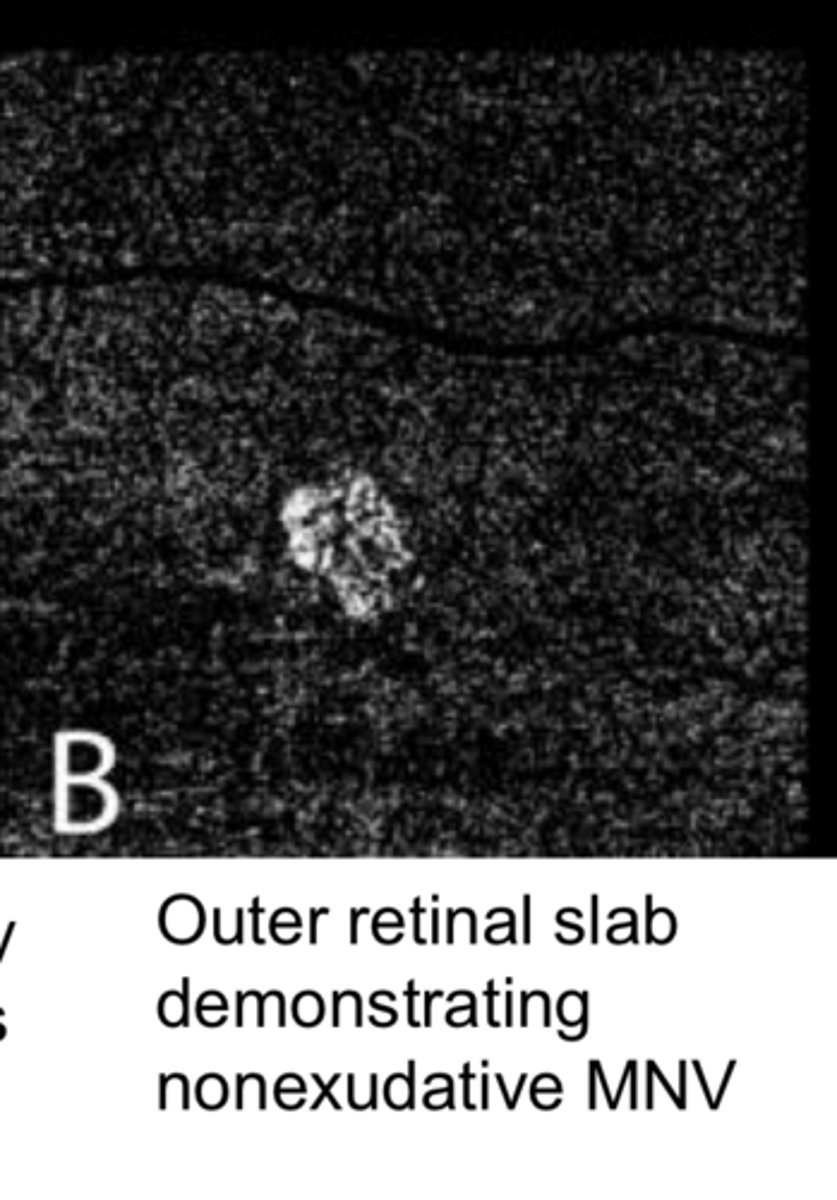 <p>RPE Detachment w/ Flow Overlay d/t Vessels (Pic)</p>