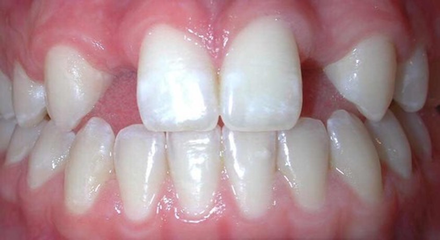 <p>Partial anodontia- one or several teeth are missing-common with conical shaped teeth.</p><p>Less than normal teeth</p>