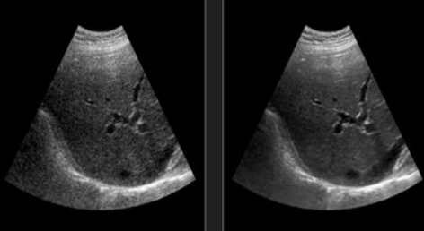 <p>(1) filtering technique that makes pictures look sharper</p><p>(2) the machine identifies and emphasizes sharp <strong><em>edge</em></strong> boundaries in the image by increasing the image contrast</p><p>(3) left image = original, right image = enhanced edges</p>