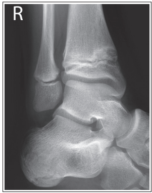 <p>What are the issues with this mortise ankle? </p>