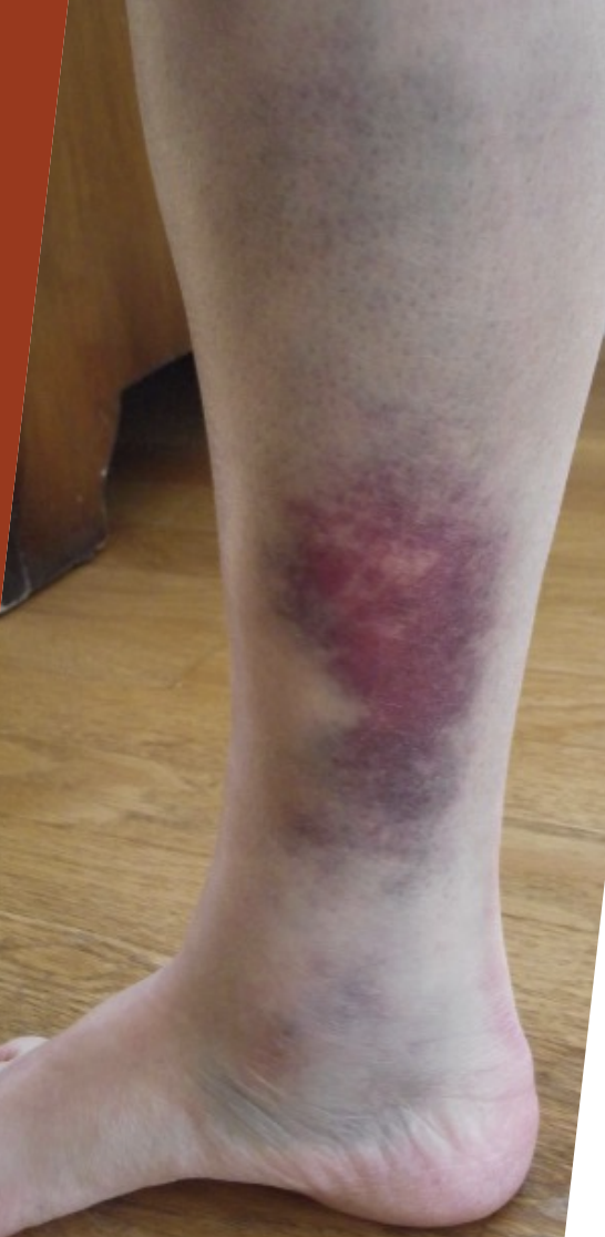 <p>Contusion</p>