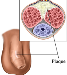 <p>= hard, nontender, subcutaneous plaques on dorsal or lateral surface palpated by stretching the penis</p><ul><li><p>usually occurs after age 45</p></li></ul>