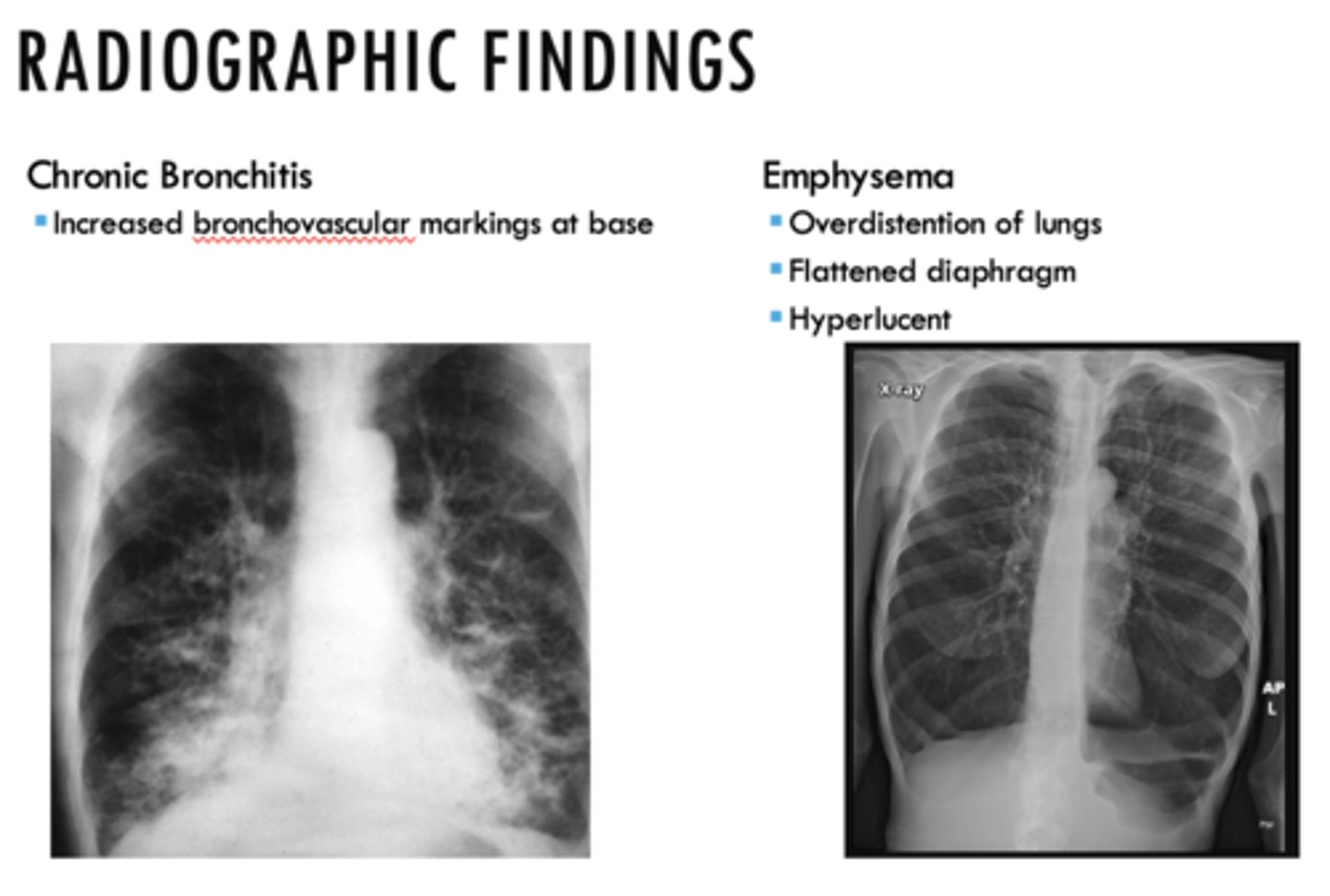 <p>Chronic bronchitis (know the associated pic!!)</p>