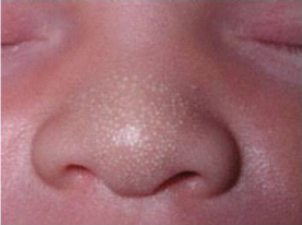 <p><strong>Milia</strong>: <strong>Background</strong></p><p>-______ rash most common in newborns</p><p>-Tiny ________ cysts filled with keratinous material </p><p>-1-2 mm white _________ occurring mostly to face (nose, _______)</p><ul><li><p>Intraoral version are ________ pearls </p></li></ul><p>-No treatment necessary </p><p>-____________ resolves over a few weeks </p><p></p>