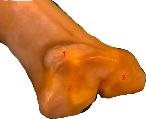 is the tuberosity medial or lateral?