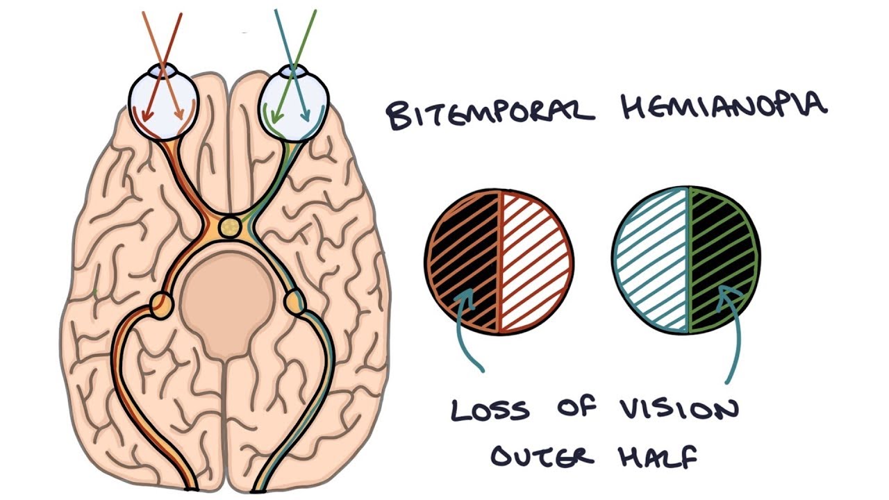 <p>loss of half of the peripheral field vision of <strong>BOTH </strong>eyes</p>