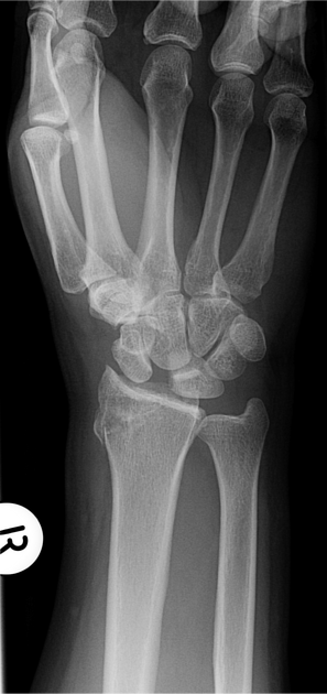 <p>Describe the abnormality demonstrated.</p>