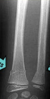 <p>What type of fracture are these?</p>