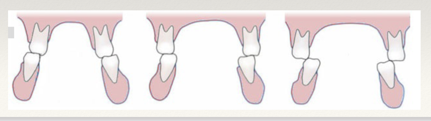 <p><span style="font-size: calc(var(--scale-factor)*22.00px);"><span>❖ </span></span><span style="font-size: calc(var(--scale-factor)*36.00px);"><span>The vestibular cusps of the upper teeth must occlude</span></span><br><span style="font-size: calc(var(--scale-factor)*36.00px);"><span>labial to the vestibular cusps of the lower arch.</span></span><br><span style="font-size: calc(var(--scale-factor)*22.00px);"><span>❖ </span></span><span style="font-size: calc(var(--scale-factor)*36.00px);"><span>Crossbite</span></span><br><span style="font-size: calc(var(--scale-factor)*22.00px);"><span>❖ </span></span><span style="font-size: calc(var(--scale-factor)*36.00px);"><span>Scissor’s bite - Brodie’s syndrome</span></span></p>