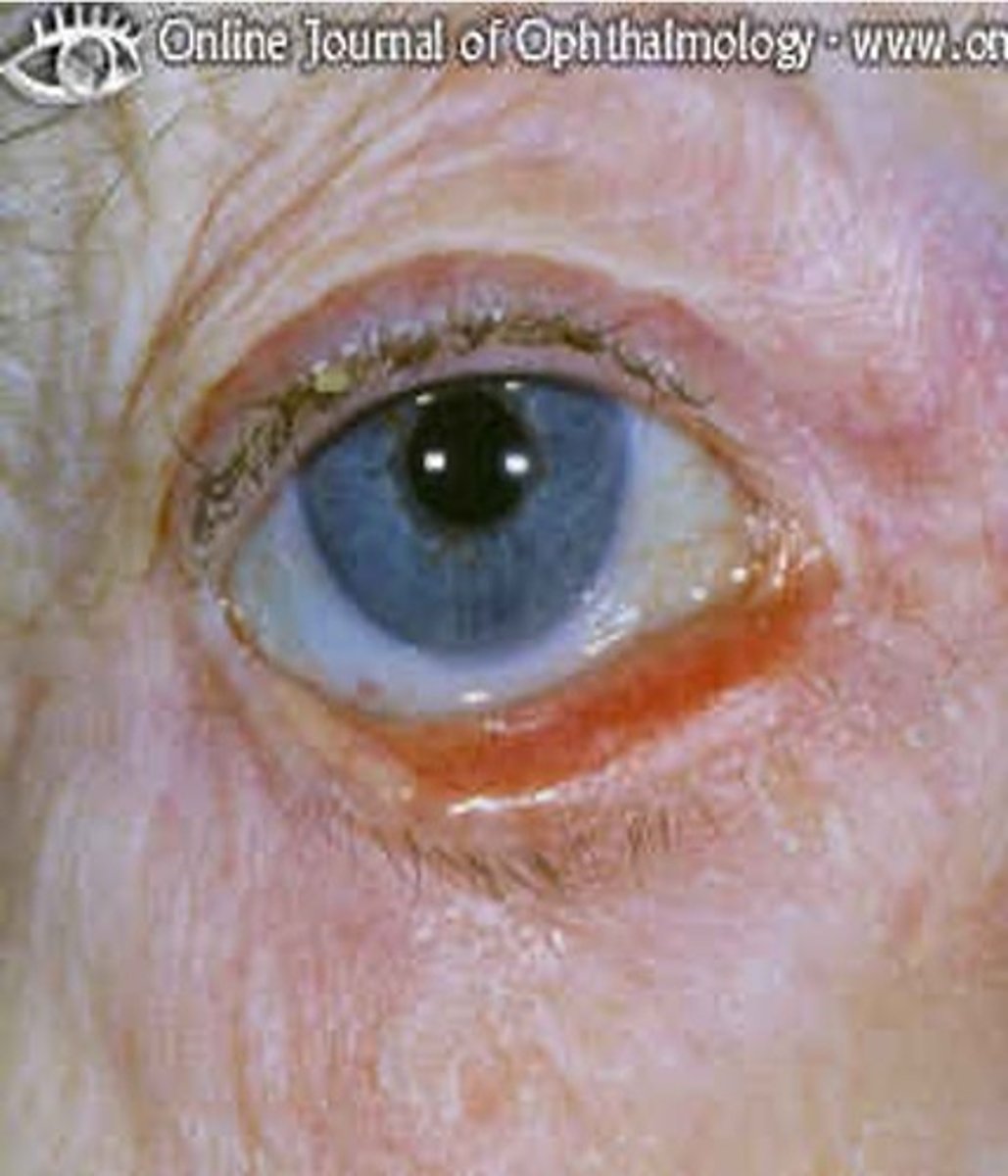 <p>out-turning of the lid margin</p><p>- more common in older patients</p><p>-occurs with less functional CN III- parasympathetic fibers that control the lower eyelid (orbicularis oculii)</p>