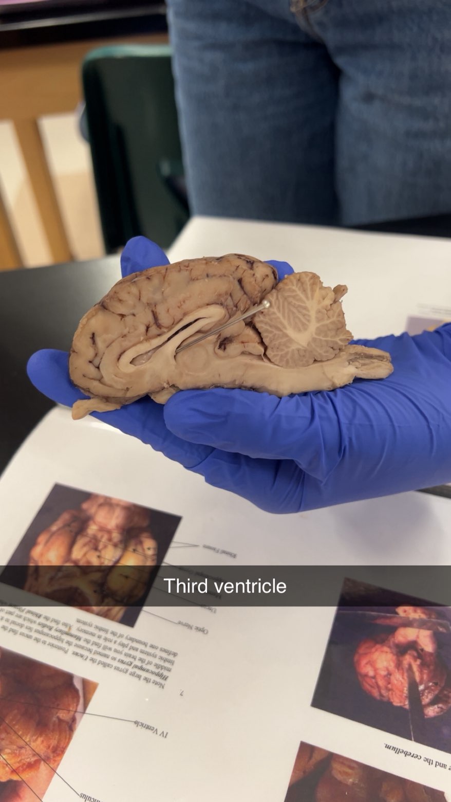 <p>3rd ventricle</p>