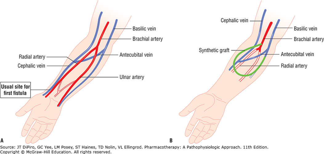 <p><span><span>A) Arteriovenous (AV) fistula: Surgical anastomosis of cephalic vein with radial artery. Blood flows from high-pressure artery leading to hypertrophy of vein. 3 months to mature</span></span></p><p style="text-align: left;"><span><span>B) Synthetic AV graft: Connects brachial artery and basilic or cephalic vein. Blood flow may be diminished in radial and ulnar arteries since blood preferentially flows into low-pressure graft.</span></span></p>