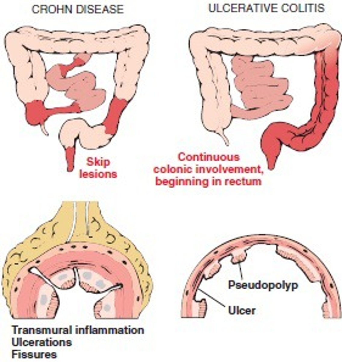 <p>(CD)</p><p>transmural inflammatory condition</p><p>can affect any part of the GI tract</p>