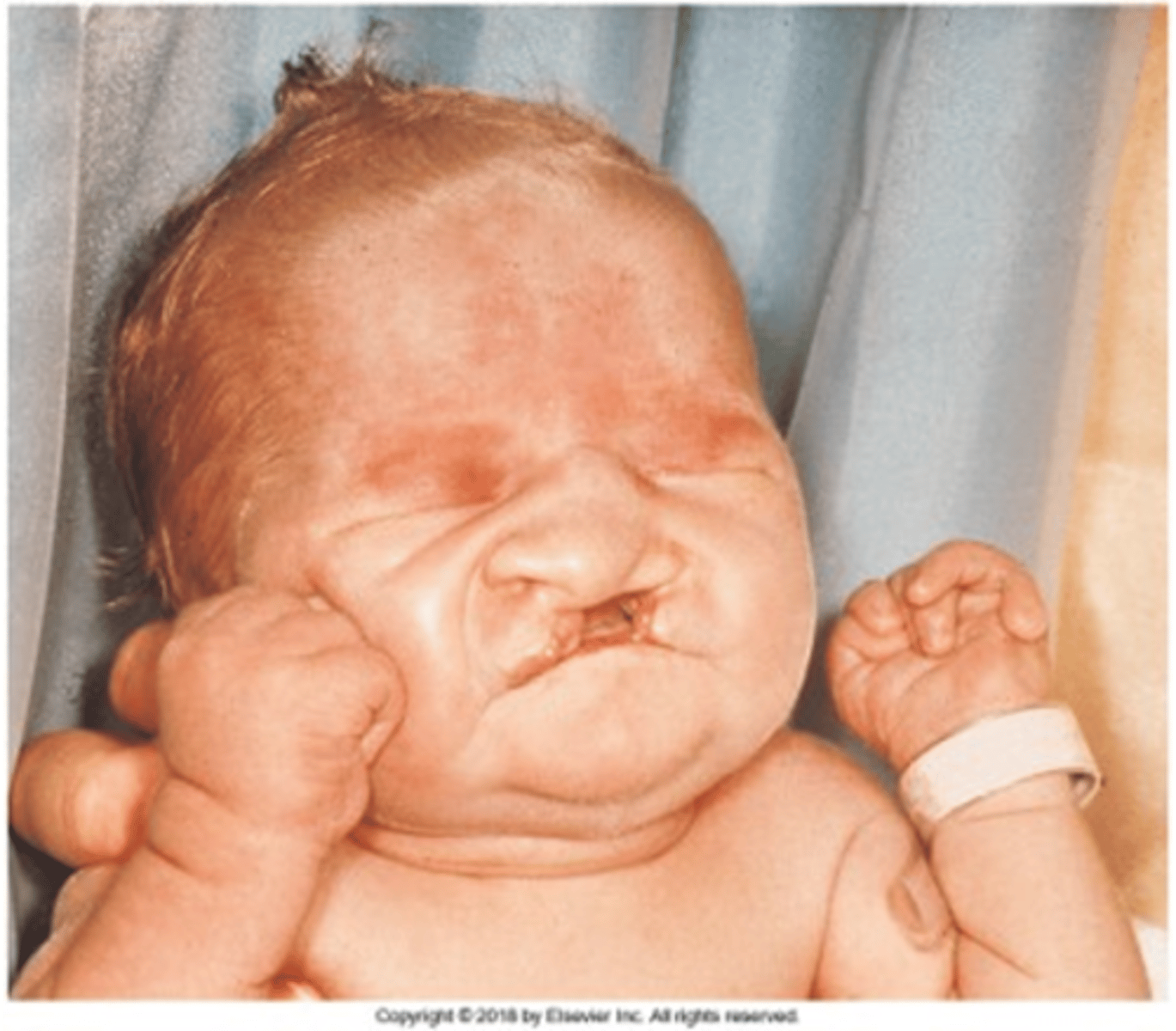 <p>bilateral cleft lip and palate, microphthalmia (small eyes) or anophthalmia (no nose), superficial hemangioma of the forehead or nape of the neck, growth retardation, severe mental handicap.</p><p>-75% of live born infants die within the first 7 months</p>