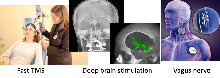 <p>Fast TMS (transcranial magnetic stimulation) → effects similar to ECT<br>Deep brain stimulation of anterior cingulate gyrus and median forebrain bundle also produces immediate effects<br>Stimulation of vagus nerve gradually relieves depression.</p>