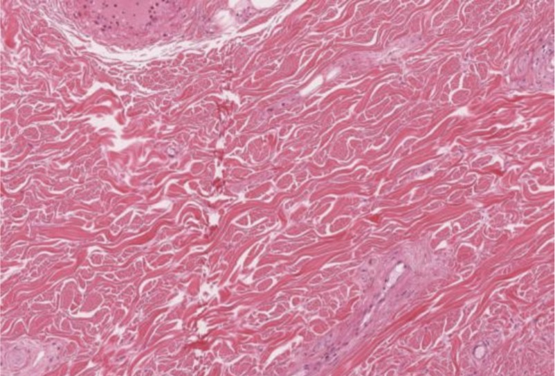 <p>Tejido conectivo denso irregular</p>