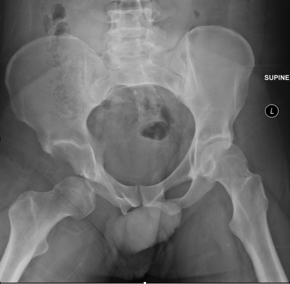 <p></p><p>skiing accident, hip ROM limited, right leg shortened &amp; internally rotated</p>