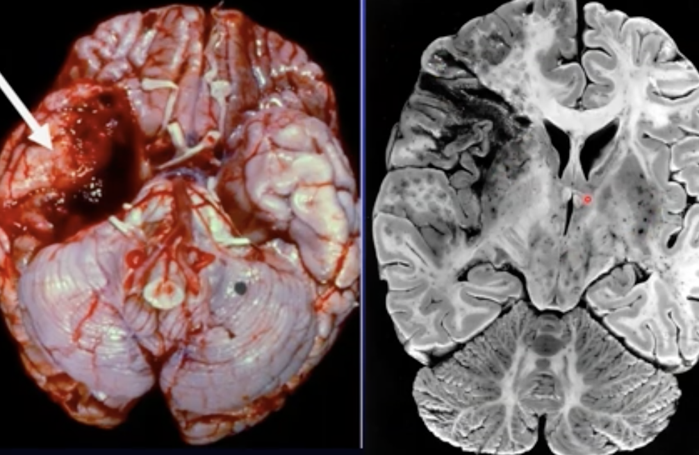 Causes encephalitis, haemorrhage in temporal lobe. The virus uses the vessel to spread around the brain and find more host cells. 