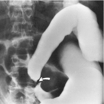 <p>Sigmoid volvulus</p>