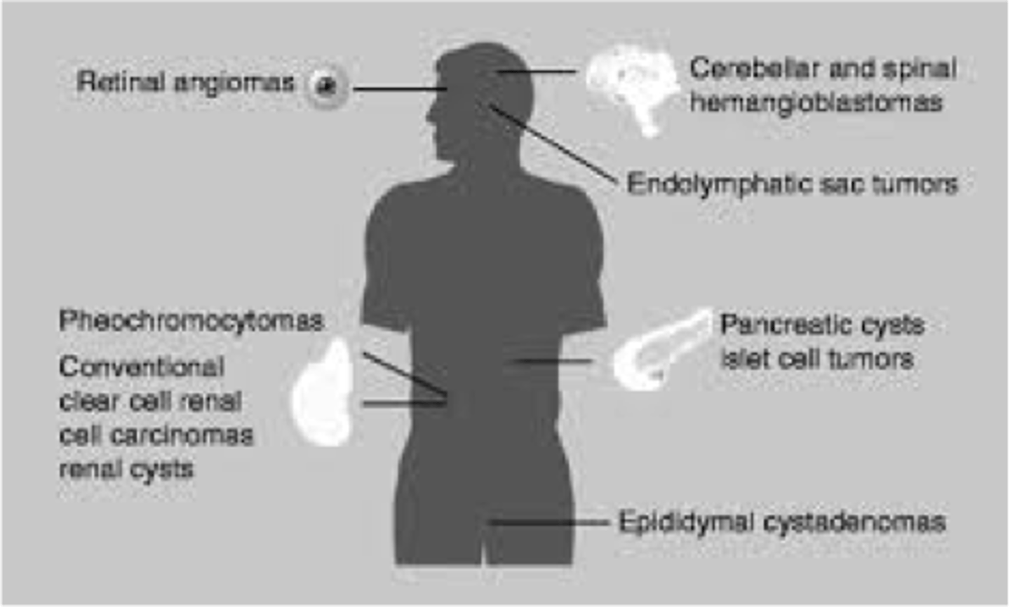 <p>von Hippel-Lindau disease (dominant tumor suppressor gene mutation)</p>