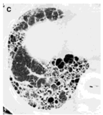 <p>Okay so the imaging comes back for our patient with progressive dyspnea and a dry cough that has appeared over the last 6 months. Spirometry shows a restrictive pattern, CXR shows increased reticular markings and ground glass, and the chest CT shows honey comb changes and ground glass opacities? What are you thinking and what could you use to completely confirm your diagnosis?</p>